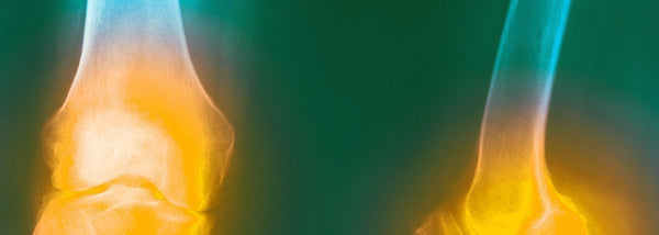 Menopauze en gewrichtspijn: oorzaken en remedies - Insentials
