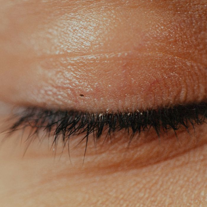 ooglidcorrectie meest uitgevoerde ingreep