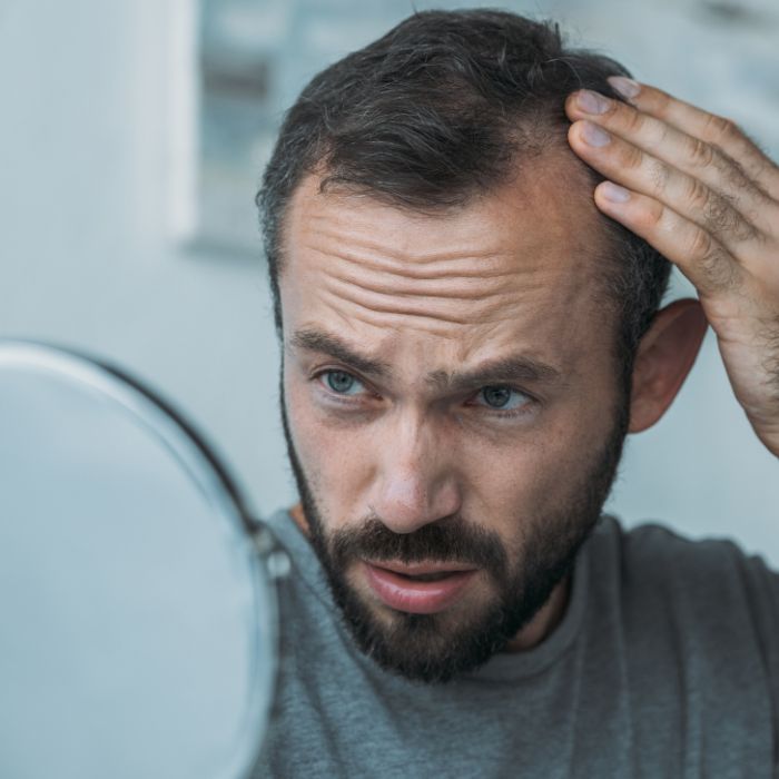 Soorten haaruitval mannen alopecia androgenetica